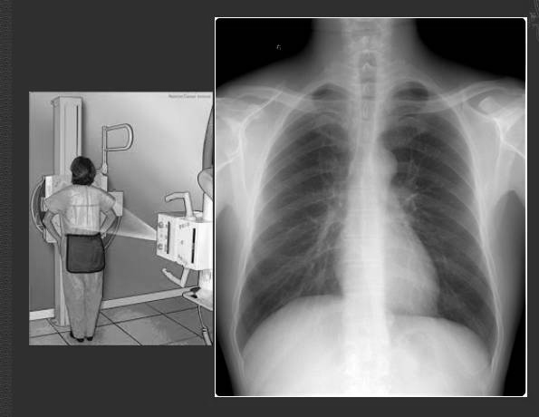 来,我教你看胸片!