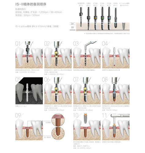 种植体系统-纽白特(北京)商贸有限公司