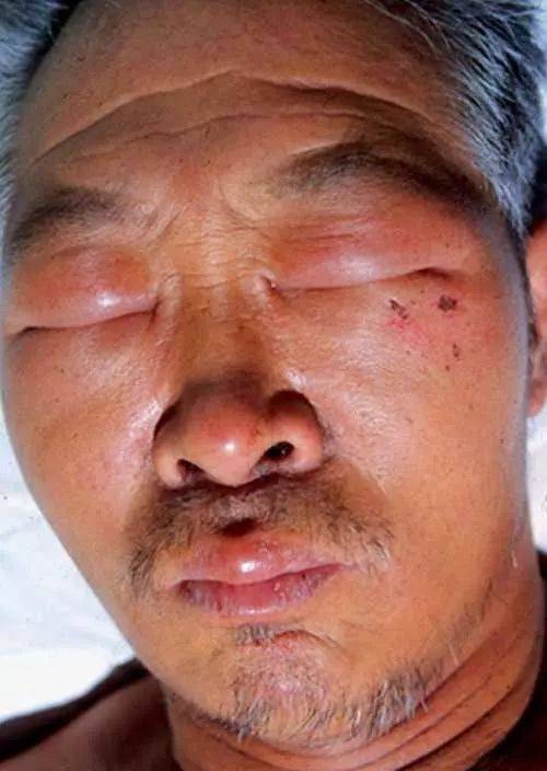 肺癌来临时会发出的3个身体暗号,早知道能救命!