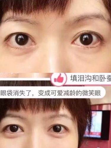 很多人人老是把眼袋和泪沟弄混,有时候是因为泪沟凹陷显得眼睛下方有