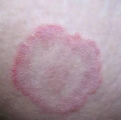 它们不是"湿疹"!不能擦激素药膏!