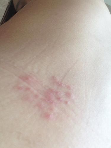 背后长了一团红色小疙瘩,疑似过敏,求判断是什么 浑身