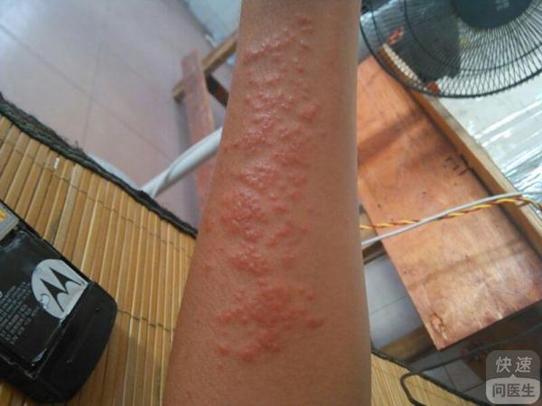 疥疮一般会长到什么部位