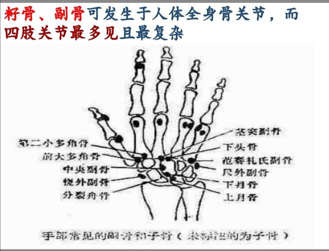 籽骨,副骨,永存骨骺与撕脱性骨折