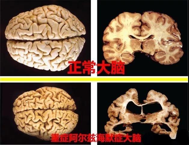 记忆力减退就是老年痴呆吗脑萎缩又是怎么回事
