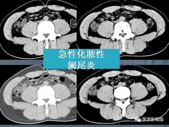 阑尾炎的ct诊断