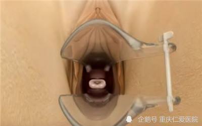 上环需要只是一个小手术,但是为了女性的健康着想,最好遵医嘱上环