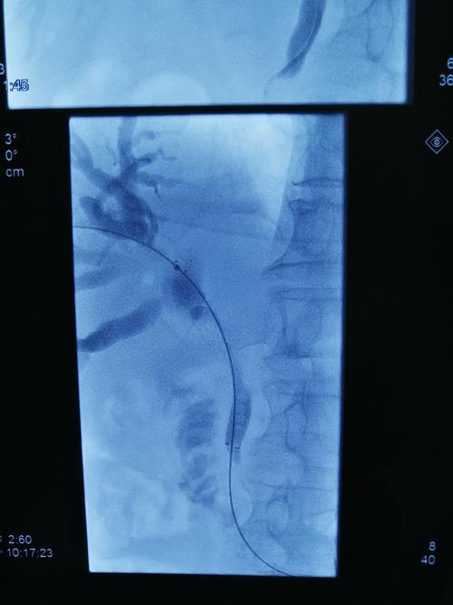 胰腺癌胆道支架减黄后海扶刀治疗病例