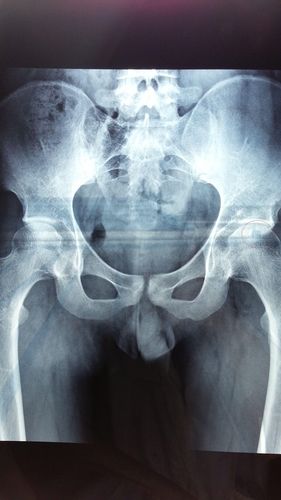 骨盆是否正位 有x光片