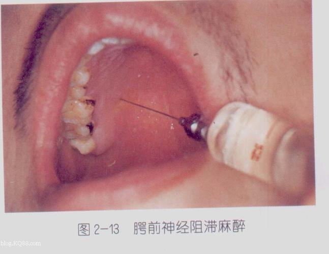 口腔局部麻醉图片集
