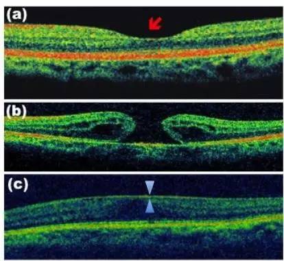 我眼里的世界怎么变形了?认识黄斑病变
