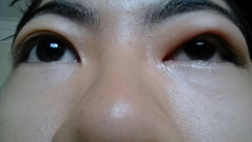 下面  感染:  女性慢性肾炎患者的发作常常与咽炎,扁桃体炎,上呼吸道