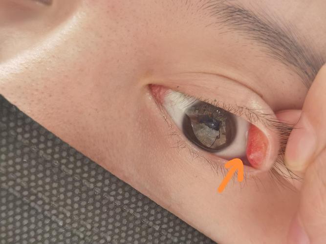 这是眼睑炎吗长了一年多了在左眼上眼皮角