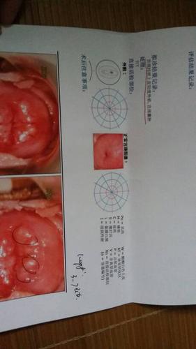 有宫颈糜烂和宫颈囊肿,没生