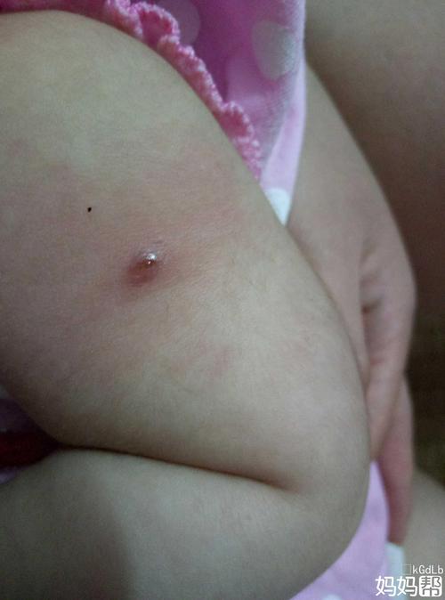 手臂打预防针位置红红的