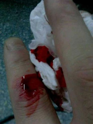 手受伤图片真实图片