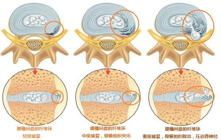 日本dst治疗-腰椎纤维环再生修复疗法