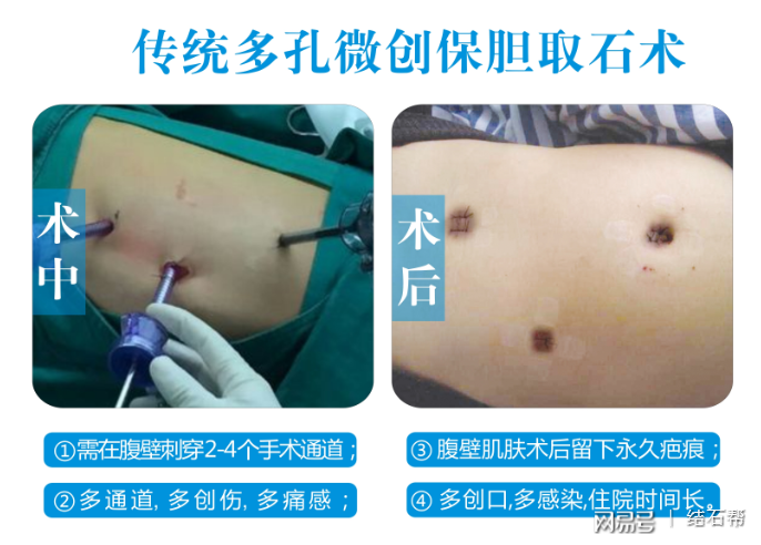 治胆结石可首选经脐无痕保胆取石
