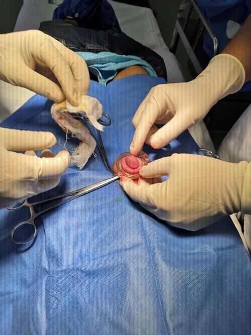 华州区人民医院普外科门诊特色手术之一包皮环切术