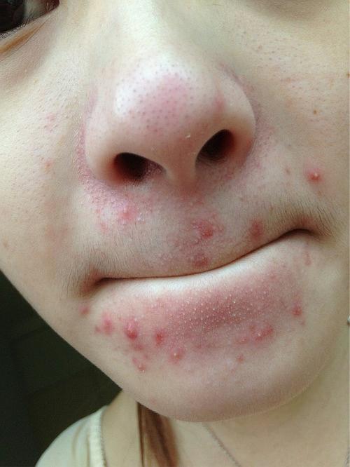 嘴巴周围长痘痘