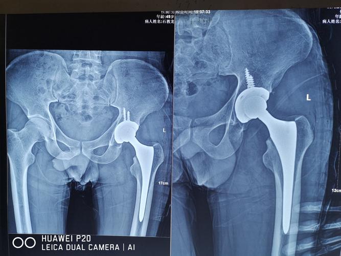 髋关节置换术.