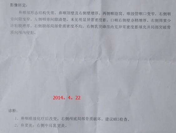 鼻咽癌ct报告书懂的帮忙看一下