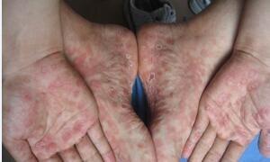 早期梅毒的症状表现