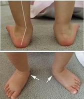 足外翻 锁定