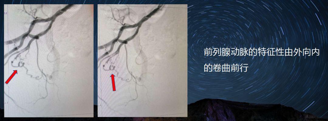 老人房颤40余年患上前列腺增生介入治疗让手术变得简单有效