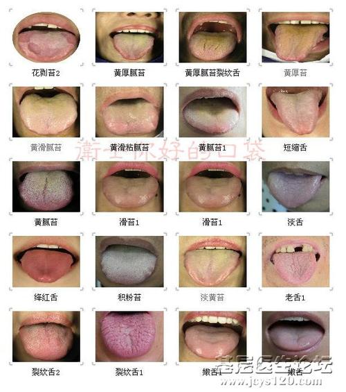 舌苔厚的人可能是患有消化系统和呼吸系统疾病;舌苔黄而厚,表明