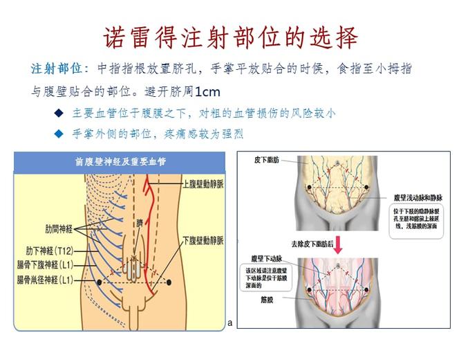 诺雷得的注射.ppt