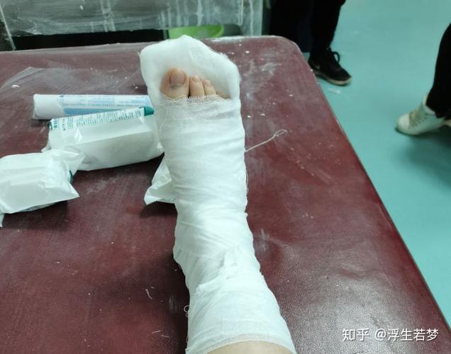 在医院,打上石膏的脚