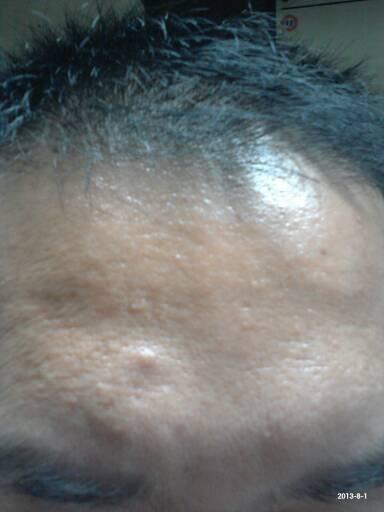 2013-09-23 郭民英 医师 鼻子上长了痘痘很久了 有时候挤出来白白的一