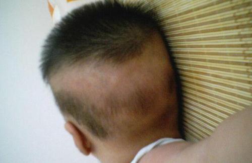 宝宝后脑勺没头发,心大妈妈却不当一回事,你家娃有"枕秃"吗