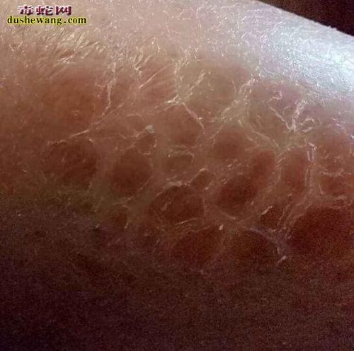 蛇鳞皮肤图片大全类似于蛇皮的鱼鳞病是什么样子的