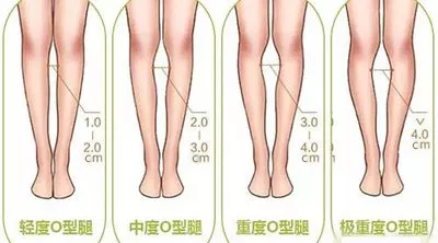 你的xo型腿,o型腿该怎么拯救?