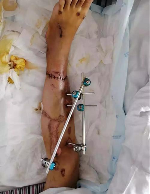 案例手足外科车祸致左腿胫腓骨粉碎性骨折杭州城东医院两期手术保住脚