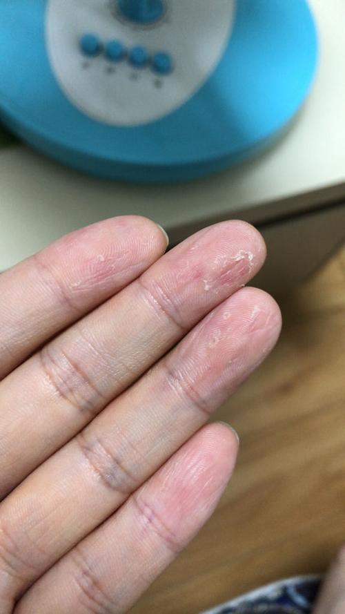 这是手癣吗?是真菌感染还是缺少维生素?