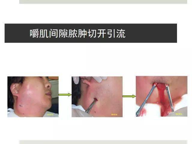 口腔颌面部间隙感染[多图]
