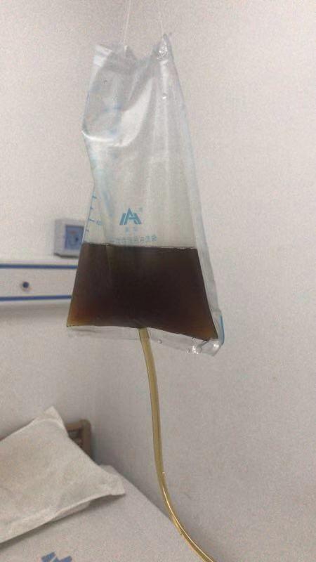 中药灌肠--更好的帮助病人排出宿便,清洁肠道,为术前做好肠道准备.