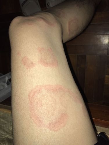 广大的网名,帮我看下这个是什么皮肤病 有人说荨麻疹,有人说环状红斑