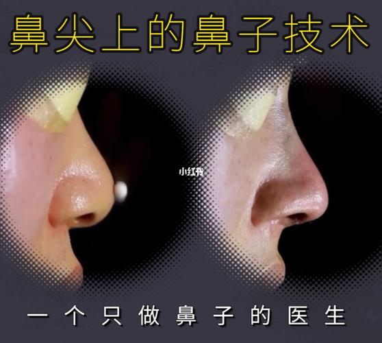 没有鼻尖表现点的鼻子一定不好看_鼻型_设计_想做个鼻子_美妆_医美