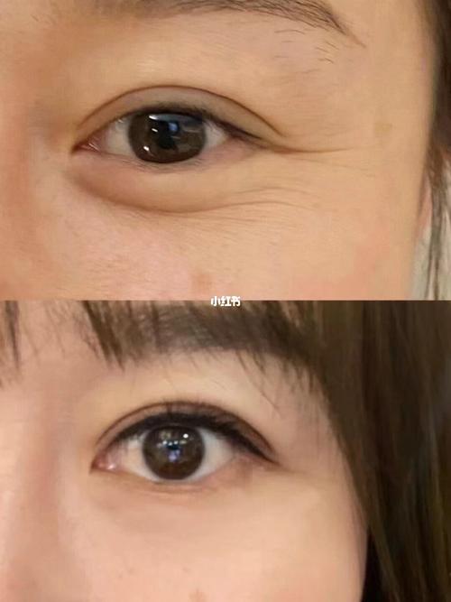 泪沟 眼下细纹 一次解决_眼袋_眼部_干纹_眼袋泪沟_美