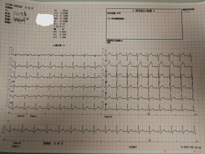 术前心电图示急性高侧壁心梗