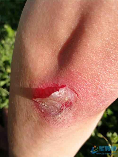 伤疤,在无言中立起"精忠报国"的好样子