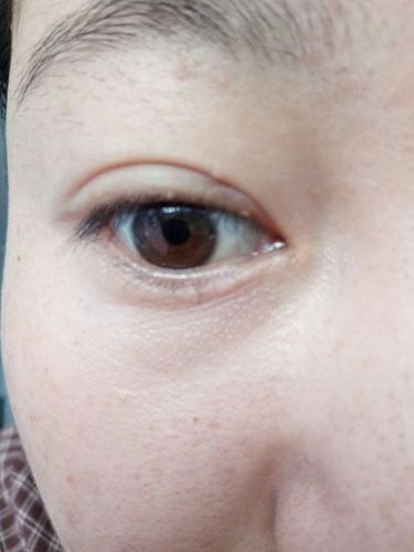 睫毛根部小颗粒是什么啊,不痛不痒,没有感觉,但一直都