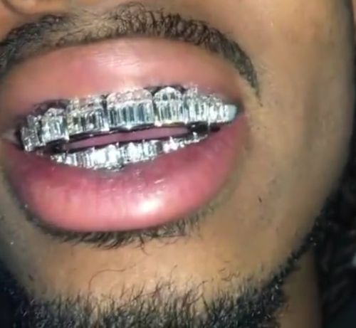 说唱歌手晒"钻石牙套",白金钻石打造值172万