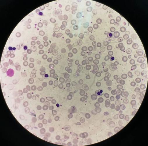 计数100个白细胞可见534个有核红细胞,用校正公式对wbc进行校正:wbc