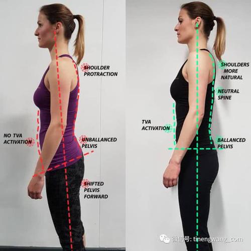 如何改善骨盆前倾