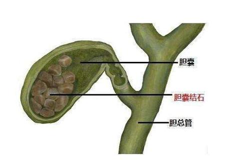 女人过了40岁须时刻提防胆囊结石